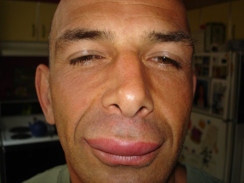 Off the Lip by Watson
Actually, this was a secondary reaction to a bug bite.....
